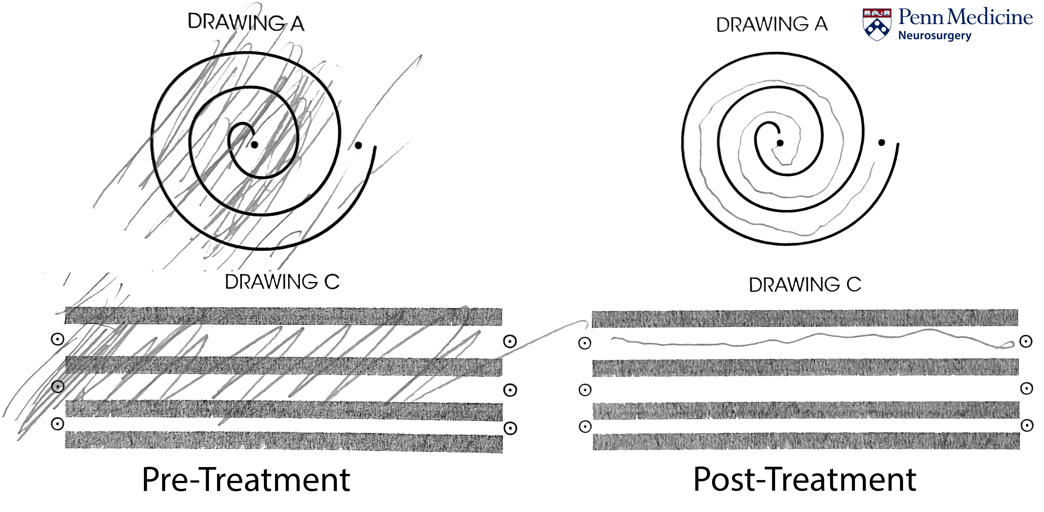 Before and After Focused Ultrasound treatment for hand tremors